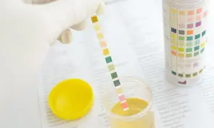 Test paskowy do analizy moczu, badanie w ciąży. Wyniki mogą wskazywać na obecność nabłonków płaskich.