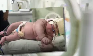 Noworodek w pieluszce leżący na poduszce, z sondą i bandażem na głowie.
