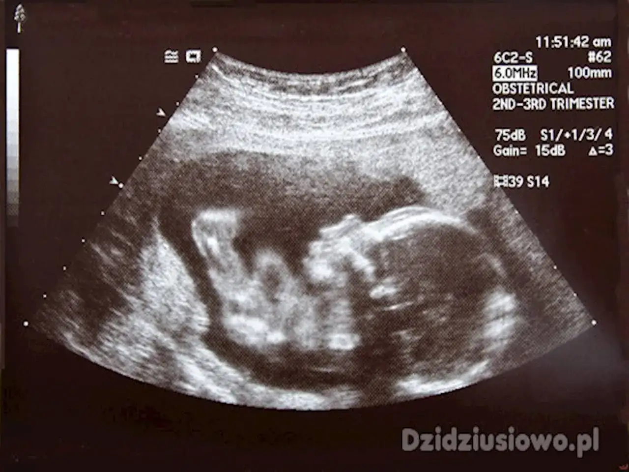USG pokazuje dziecko w 5 miesiącu ciąży. Widać jego główkę i zarys ciała.